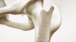 Knochenaufbau Osteoporose